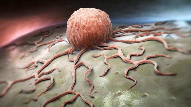 Tumor